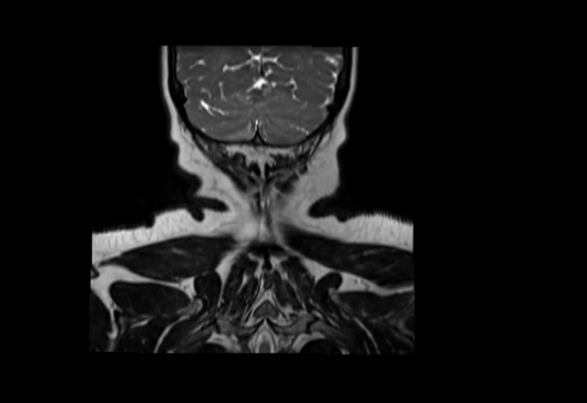 Neck coronal lymph node cross sectional MRI anatomy 3T MRI  image-img-00001-00006.webp